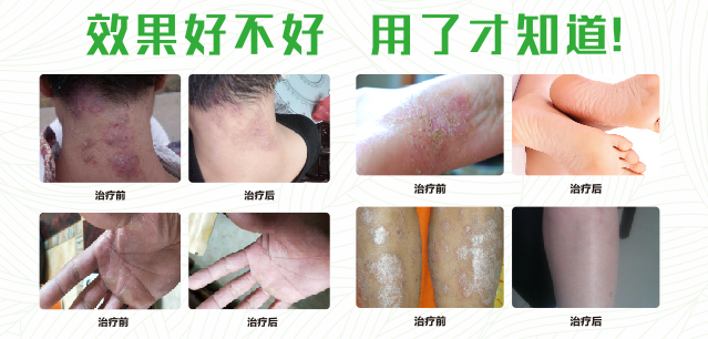 91视频软件下载真菌清喷剂